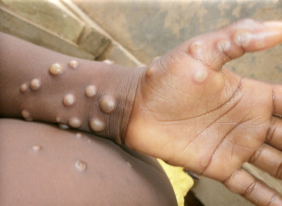 Confirmed cases of monkeypox in Ghana 1